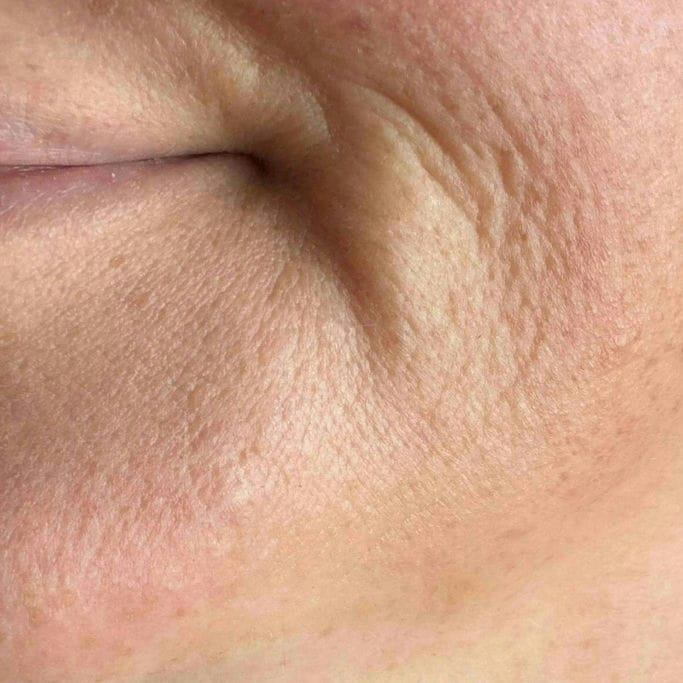  PELLE SECCA  
Produce poco sebo e tende a perdere comfort. Può apparire fragile, poco luminosa e soggetta a tensione e desquamazione.