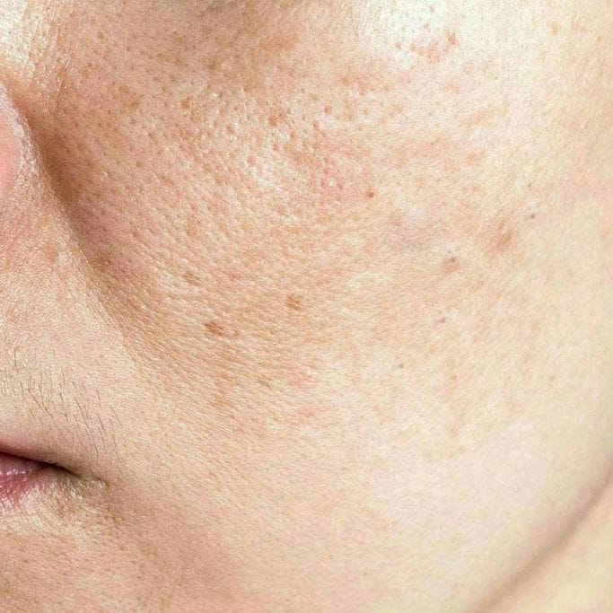  PELLE GRASSA  

Produzione sebacea elevata, lucidità diffusa e maggiore predisposizione a pori evidenti e imperfezioni.