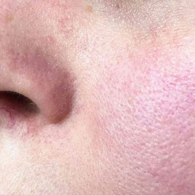  PELLE MISTA  

Distribuzione disomogenea del sebo: zona T più attiva e guance più normali o disidratate. Richiede un trattamento riequilibrante.