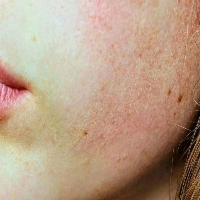  PELLE SENSIBILE  

Cute reattiva e delicata, tende ad arrossarsi facilmente e a manifestare fastidio, secchezza e prurito in risposta a stimoli esterni.