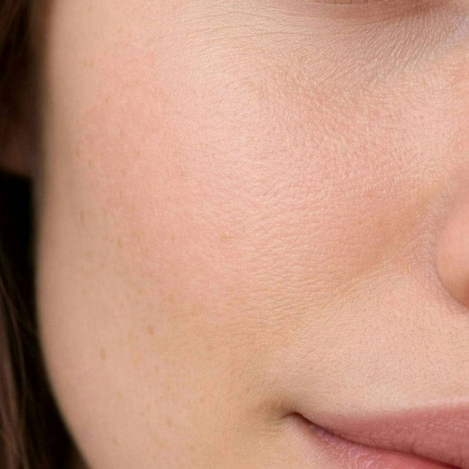  PELLE NORMALE  

Equilibrio fisiologico stabile, texture uniforme e buona tolleranza ai trattamenti.