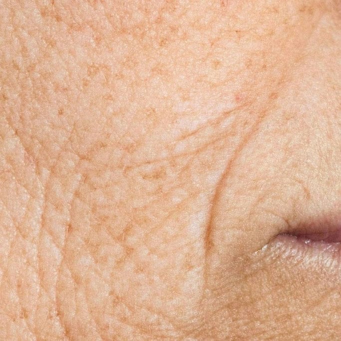  PELLE MATURA  

Riduzione progressiva di tono ed elasticità, con segni del tempo più evidenti e minore capacità di rigenerazione.